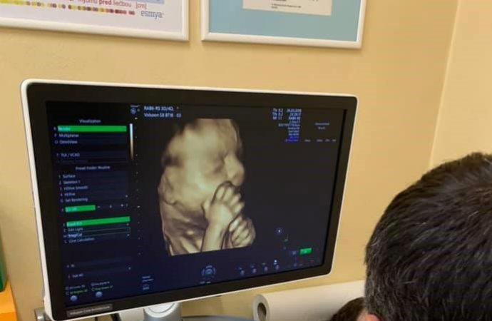 Ústredná vojenská nemocnica má nový 3D/4D ultrazvuk